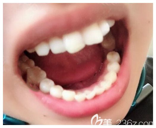 我在青島維樂口腔做種植牙前的照片 我在青島維樂口腔做種植牙前的照片