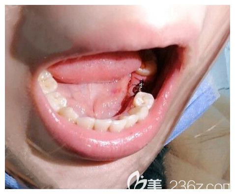 我在維樂口腔做種植牙手術(shù)中 我在維樂口腔做種植牙手術(shù)中