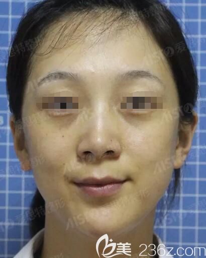 面診無錫愛思特術(shù)前面部出油干燥 面診無錫愛思特術(shù)前面部出油干燥