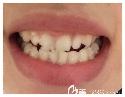 眼見(jiàn)為實(shí),上傳本人在青島維樂(lè)口腔做微創(chuàng)種植牙前后照片和親身經(jīng)歷