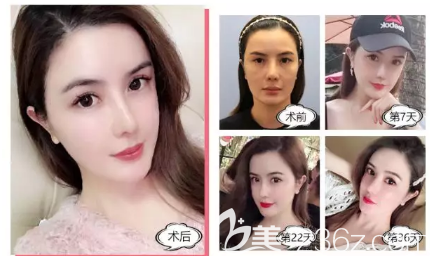 深圳麗港麗格石東文做自體脂肪填充全臉效果圖 深圳麗港麗格石東文做自體脂肪填充全臉效果圖