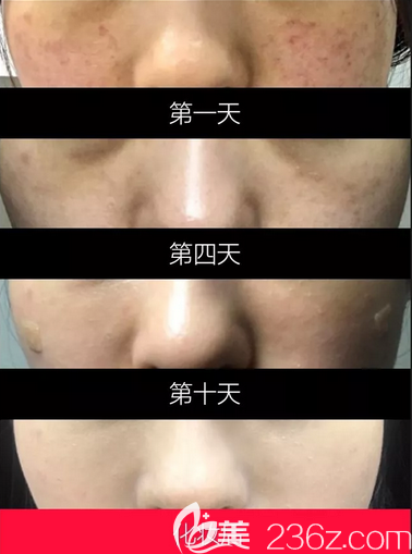 韓國美璞兒激光去色斑+光子嫩膚案例效果對比圖