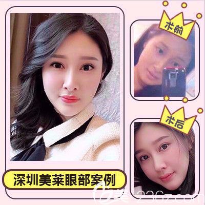 深圳美萊肖峰醫(yī)生雙眼皮案例 深圳美萊肖峰醫(yī)生雙眼皮案例