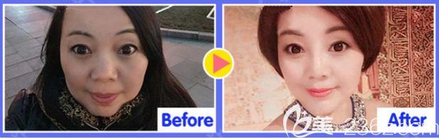 遵義韓美線雕提升