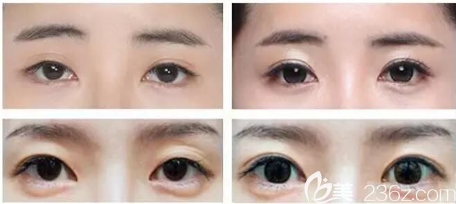 王展醫(yī)生眼綜合案例 王展醫(yī)生眼綜合案例