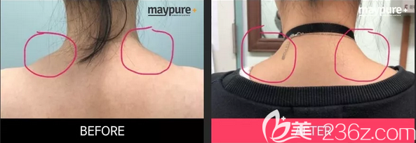 韓國(guó)美璞兒張俊哲瘦肩注射位置圖片前后效果對(duì)比 韓國(guó)美璞兒張俊哲瘦肩注射位置圖片前后效果對(duì)比