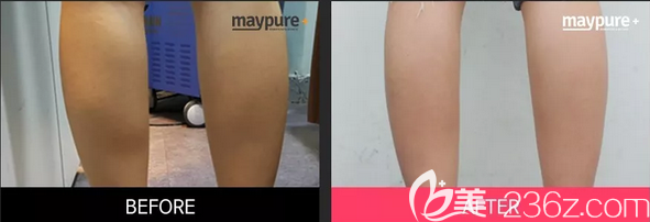 韓國(guó)美璞兒瘦腿圖片對(duì)比照片 韓國(guó)美璞兒瘦腿圖片對(duì)比照片