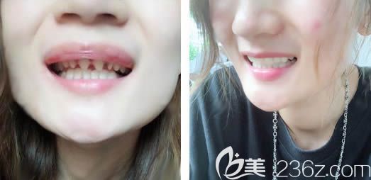 廈門登特口腔詹明毅全瓷牙修復(fù)效果對比圖 廈門登特口腔詹明毅全瓷牙修復(fù)效果對比圖