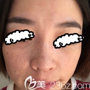 我在青海西寧時光醫(yī)院激光祛斑術后第7天