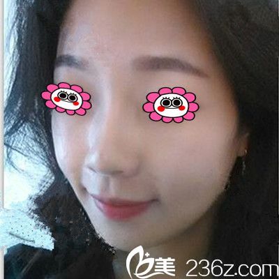 在衡陽曹家整形隆鼻前的照片 在衡陽曹家整形隆鼻前的照片