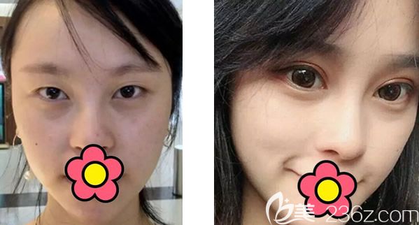 呼和浩特大韓陳琳院長真人全切雙眼皮7mm第七天拆線后