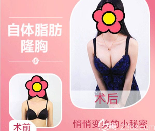呼和浩特大韓整形權(quán)純弘博士自體脂肪豐胸效果怎么樣