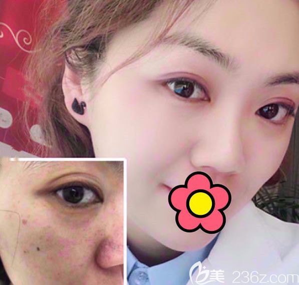 呼市大韓整形醫(yī)院注射前后效果對比照片