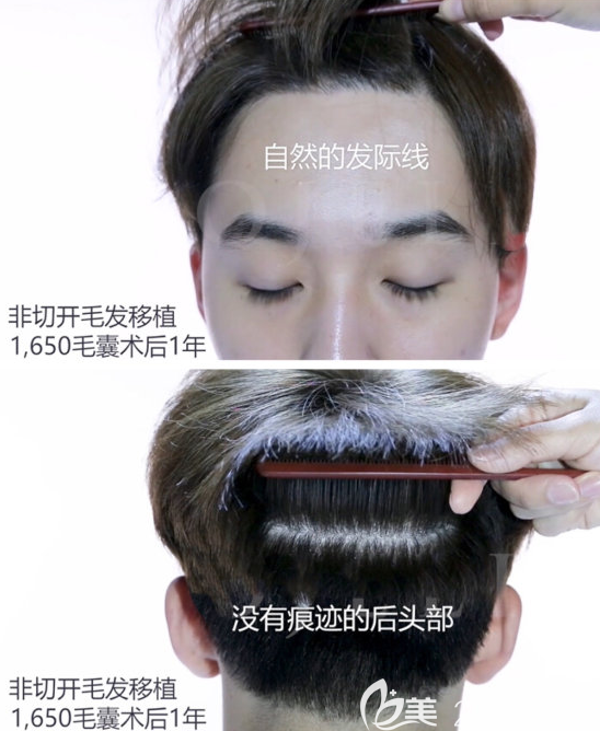 韓國毛杰琳非切開式發(fā)際線種植案例