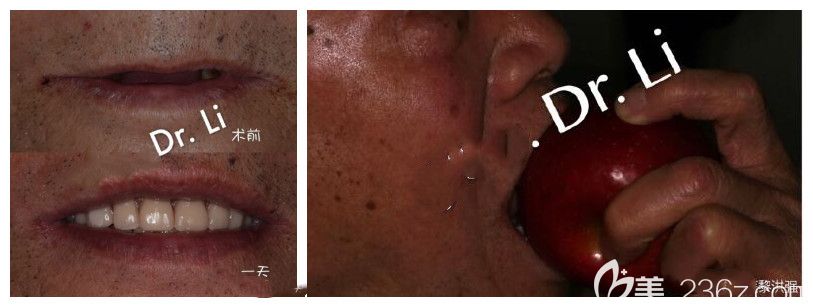 中山好民生口腔黎洪強(qiáng)牙齒種植案例 中山好民生口腔黎洪強(qiáng)牙齒種植案例