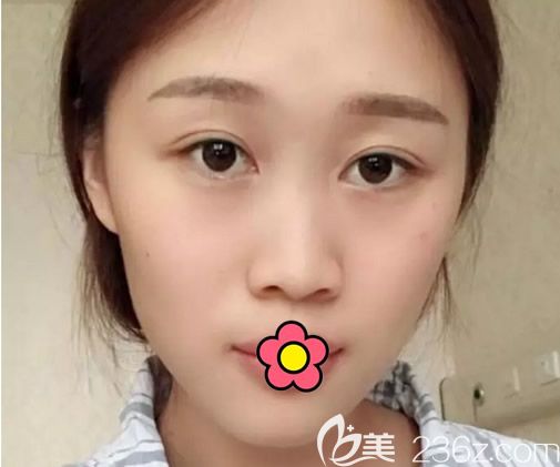 呼和浩特大韓整形找金成植院長做鼻綜合隆鼻前 呼和浩特大韓整形找金成植院長做鼻綜合隆鼻前