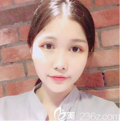 朱曉梅醫(yī)生眼綜合術后三天效果圖