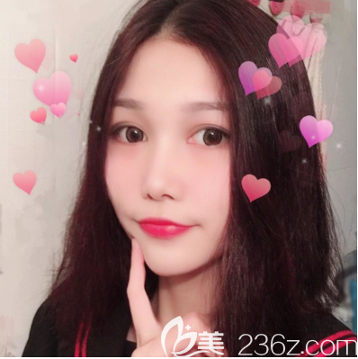 東莞維多利亞朱曉梅醫(yī)生雙眼皮手術案例