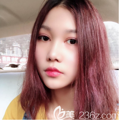 看閨蜜在東莞維多利亞做的雙眼皮效果不錯,我也去找朱曉梅醫(yī)生做了眼綜合