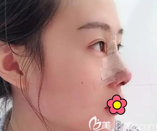 大韓整形金成植博士假體隆鼻+耳軟骨墊鼻尖第四天效果 大韓整形金成植博士假體隆鼻+耳軟骨墊鼻尖第四天效果