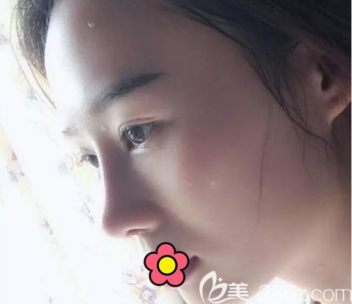 硅膠假體隆鼻第20天恢復(fù)圖 硅膠假體隆鼻第20天恢復(fù)圖