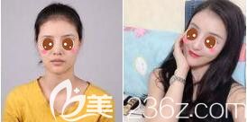 <!--<i data=20240703-sp></i>-->華美隆鼻真人