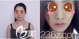 <!--<i data=20240703-sp></i>-->伊萊美隆鼻真人