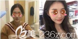 <!--<i data=20240703-sp></i>-->美萊隆鼻真人