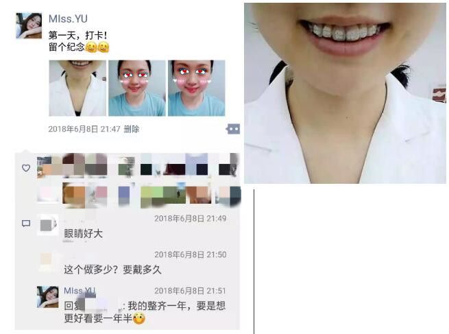 好民生口腔初戴進(jìn)口陶瓷半隱形牙套 好民生口腔初戴進(jìn)口陶瓷半隱形牙套