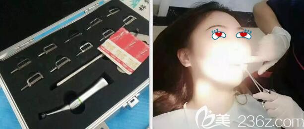 中山好民生口腔牙齒矯正片切過(guò)程 中山好民生口腔牙齒矯正片切過(guò)程