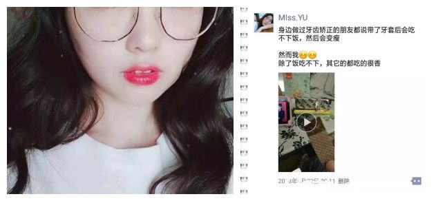 雷永正戴牙套矯正過(guò)程體驗(yàn) 雷永正戴牙套矯正過(guò)程體驗(yàn)