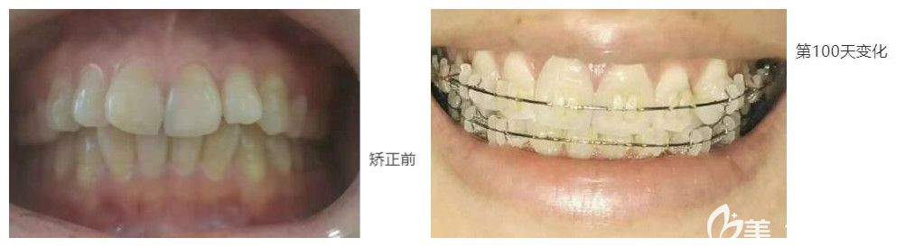 中山好民生矯正100天和矯正前對(duì)比照片 中山好民生矯正100天和矯正前對(duì)比照片