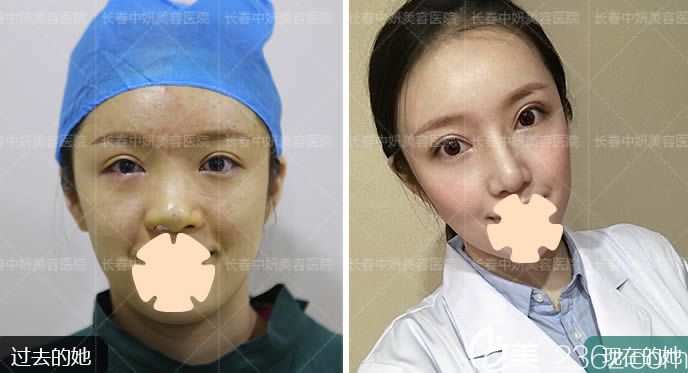 長(zhǎng)春中妍整形趙勝友鼻綜合案例效果對(duì)比圖