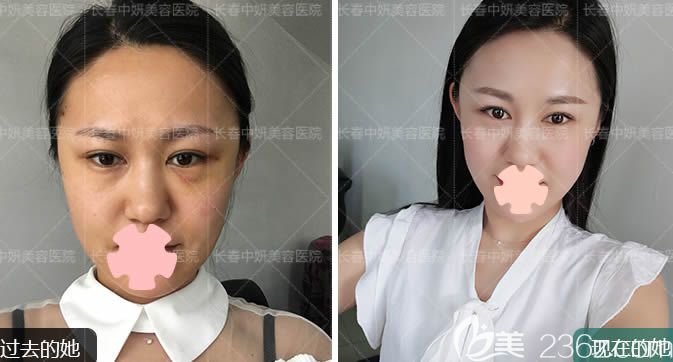 長(zhǎng)春中妍整形美容全面部線雕提升效果對(duì)比