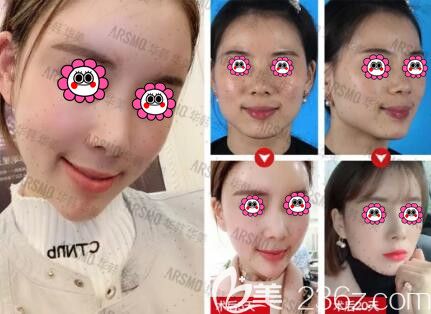 黃旭培自體脂肪全面部填充真人前后對(duì)比照