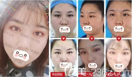 黃旭培ARSMO高端美眼真人前后對(duì)比照