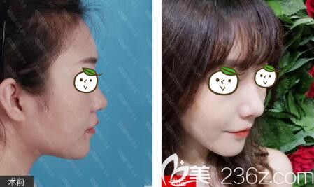 黃旭培院長(zhǎng)鼻部整形真人前后對(duì)比效果