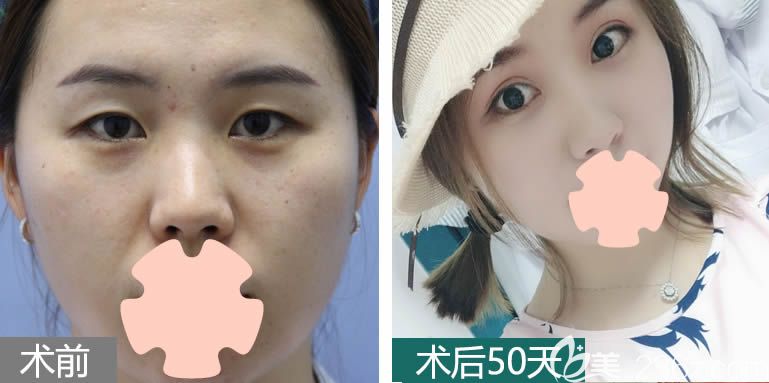 長(zhǎng)春中妍整形美容特色重瞼術(shù)案例效果