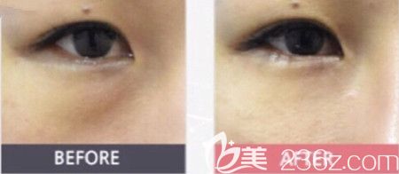 韓國(guó)DIVA眼底脂肪重置手術(shù)案例