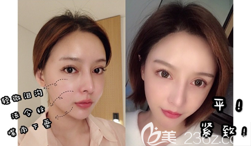 韓國(guó)DIVA面部案例