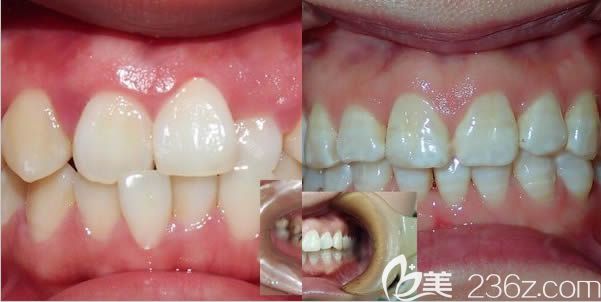 廈門登特口腔醫(yī)院正畸案例效果對比圖 廈門登特口腔醫(yī)院正畸案例效果對比圖