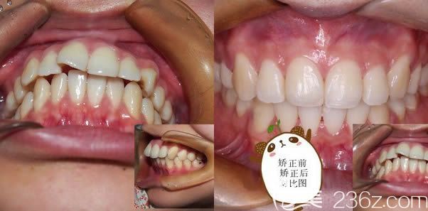 廈門登特口腔暴牙矯正效果前后對比圖 廈門登特口腔暴牙矯正效果前后對比圖
