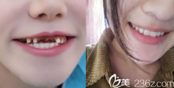 廈門登特口腔連鎖前牙種植前后對比效果圖 廈門登特口腔連鎖前牙種植前后對比效果圖