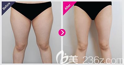 韓國perfectline整形外<!--<i data=20240703-sp></i>-->腿吸脂案例