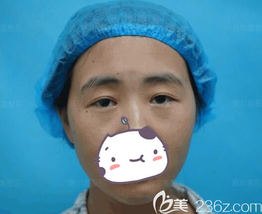 面診江蘇施爾美術(shù)前埋線雙眼皮失敗 面診江蘇施爾美術(shù)前埋線雙眼皮失敗