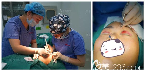 孫欣醫(yī)生做雙眼皮失敗修復(fù)手術(shù)中 孫欣醫(yī)生做雙眼皮失敗修復(fù)手術(shù)中