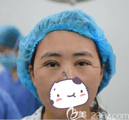 剛做完埋線雙眼皮失敗修復(fù)術(shù)后即刻 剛做完埋線雙眼皮失敗修復(fù)術(shù)后即刻