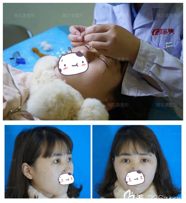 術(shù)后一周到江蘇施爾美做拆線后雙眼皮恢復(fù)情況 術(shù)后一周到江蘇施爾美做拆線后雙眼皮恢復(fù)情況