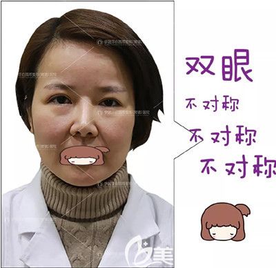 雙眼皮修復(fù)手術(shù)前的照片 雙眼皮修復(fù)手術(shù)前的照片