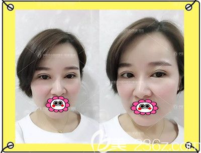 雙眼皮修復(fù)術(shù)后3個(gè)月變化圖 雙眼皮修復(fù)術(shù)后3個(gè)月變化圖